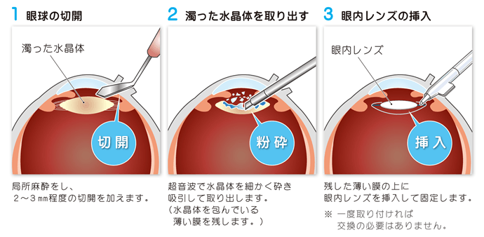 白内障手術