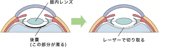 後発白内障の治療