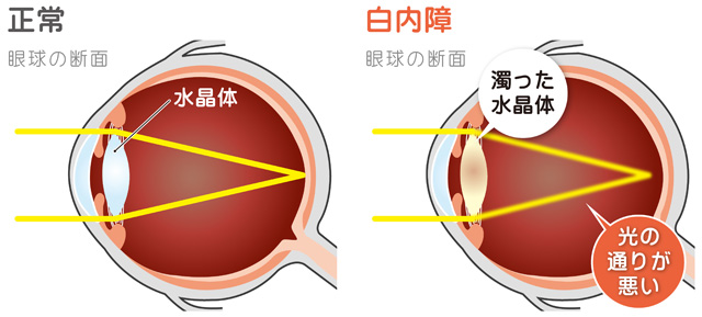 白内障