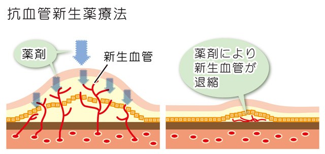 抗VEGF療法